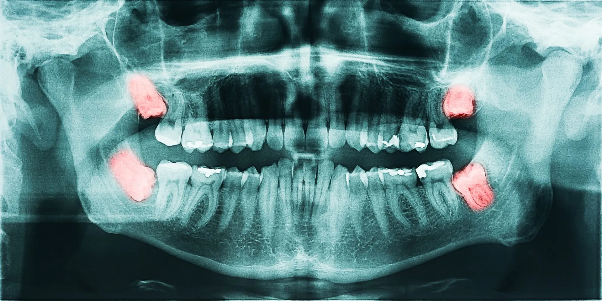 Dentist Marrakech, dental care Marrakech, Dentiste Marrakech