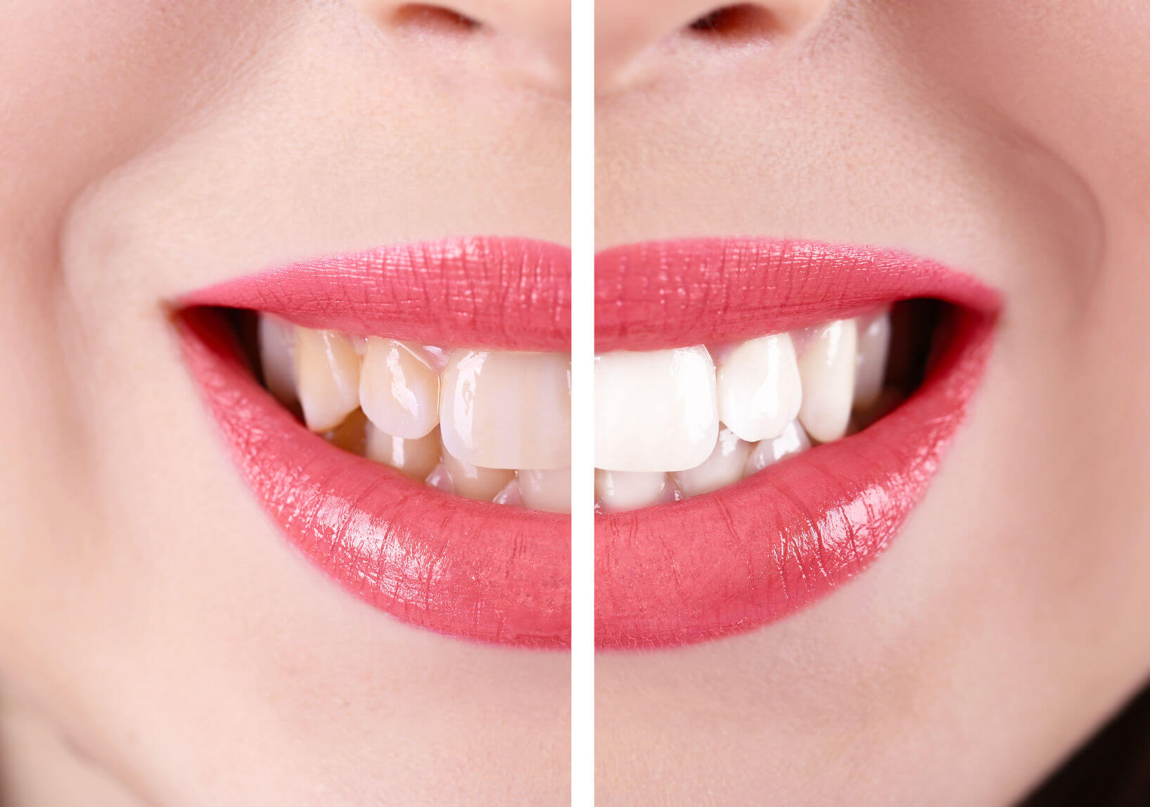 Professional Teeth Whitening at YC Dental Care, Trusted Dentist Marrakech